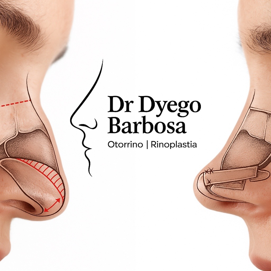Dr Dyego Barbosa - Rinoplastia estruturada